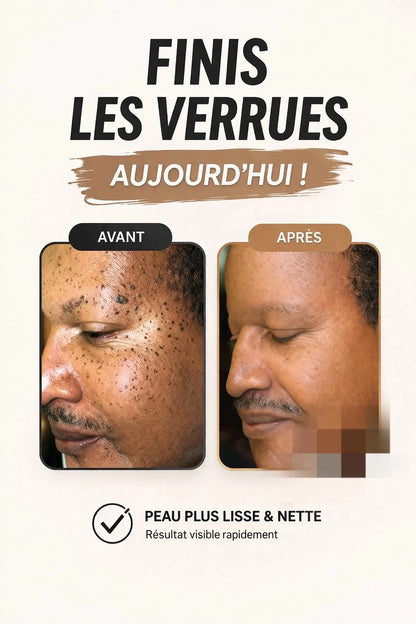 Crème Anti Verrues